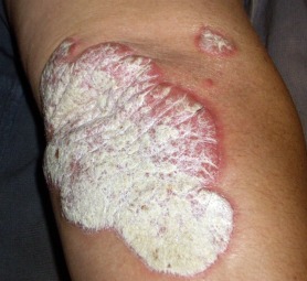 A picture of real plaque psoriasis on an elbow.