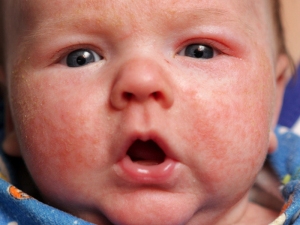 This child has atopic dermatitis. Putting human breast milk on it probably will not help.